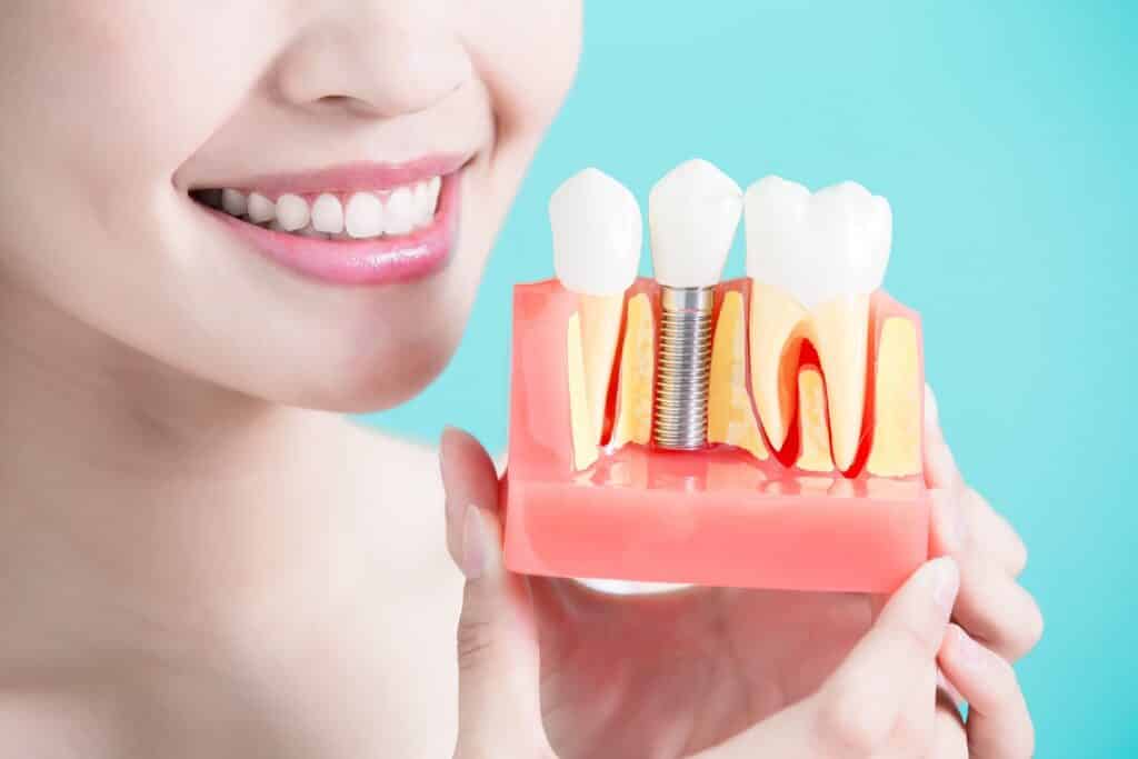 Dental Implants Cost in Gisborne