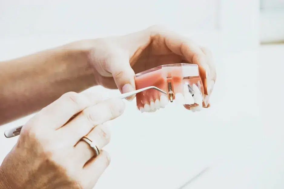 Tooth-Implants